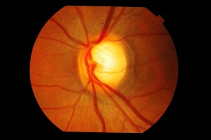 glaucoma