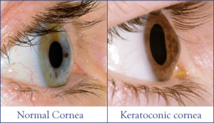 keratoconus