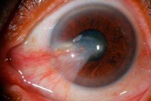 1280px-Pterygium_Slitlamp