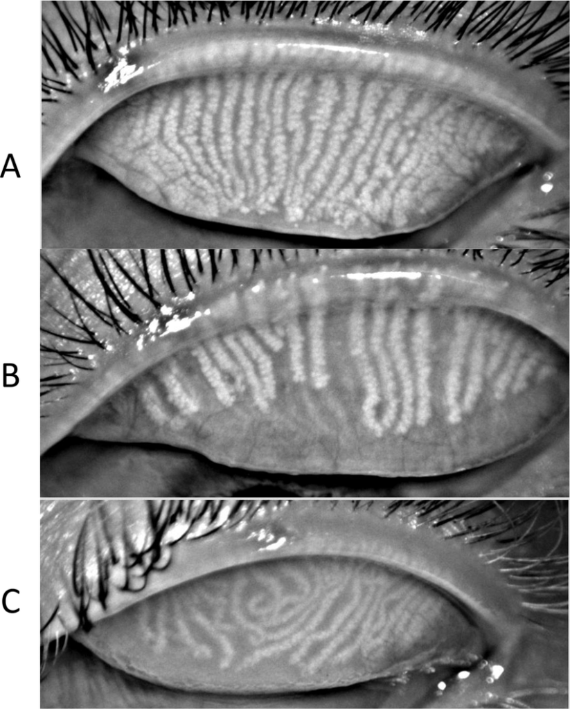 Normal Meibomian Glands MEIBOMIAN GLAND IMAGING AND EXPRESSION Dry Normal Meibomian Glands MEIBOMIAN GLAND IMAGING AND EXPRESSION Dry